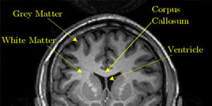 Injury to Brain Matter