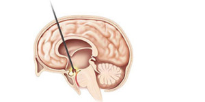 Endoscopic Third Ventriculostomy