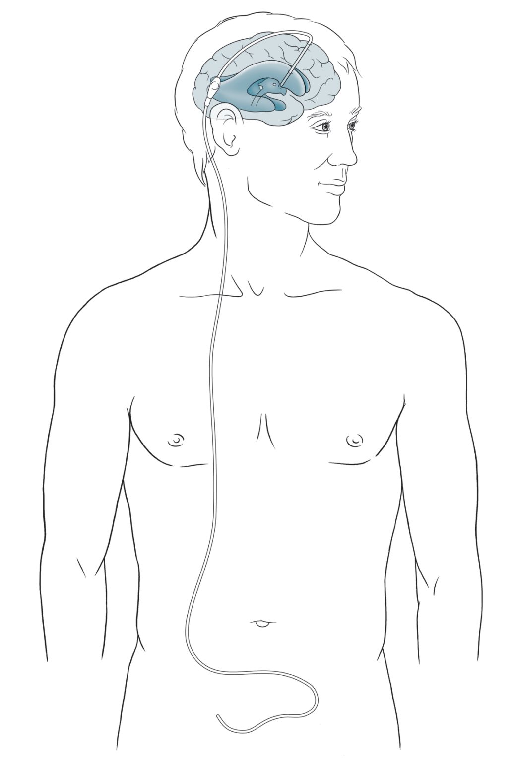 What is a Shunt? Learn about Hydrocephalus shunts.
