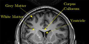 Image scan of Grey Matter Injury