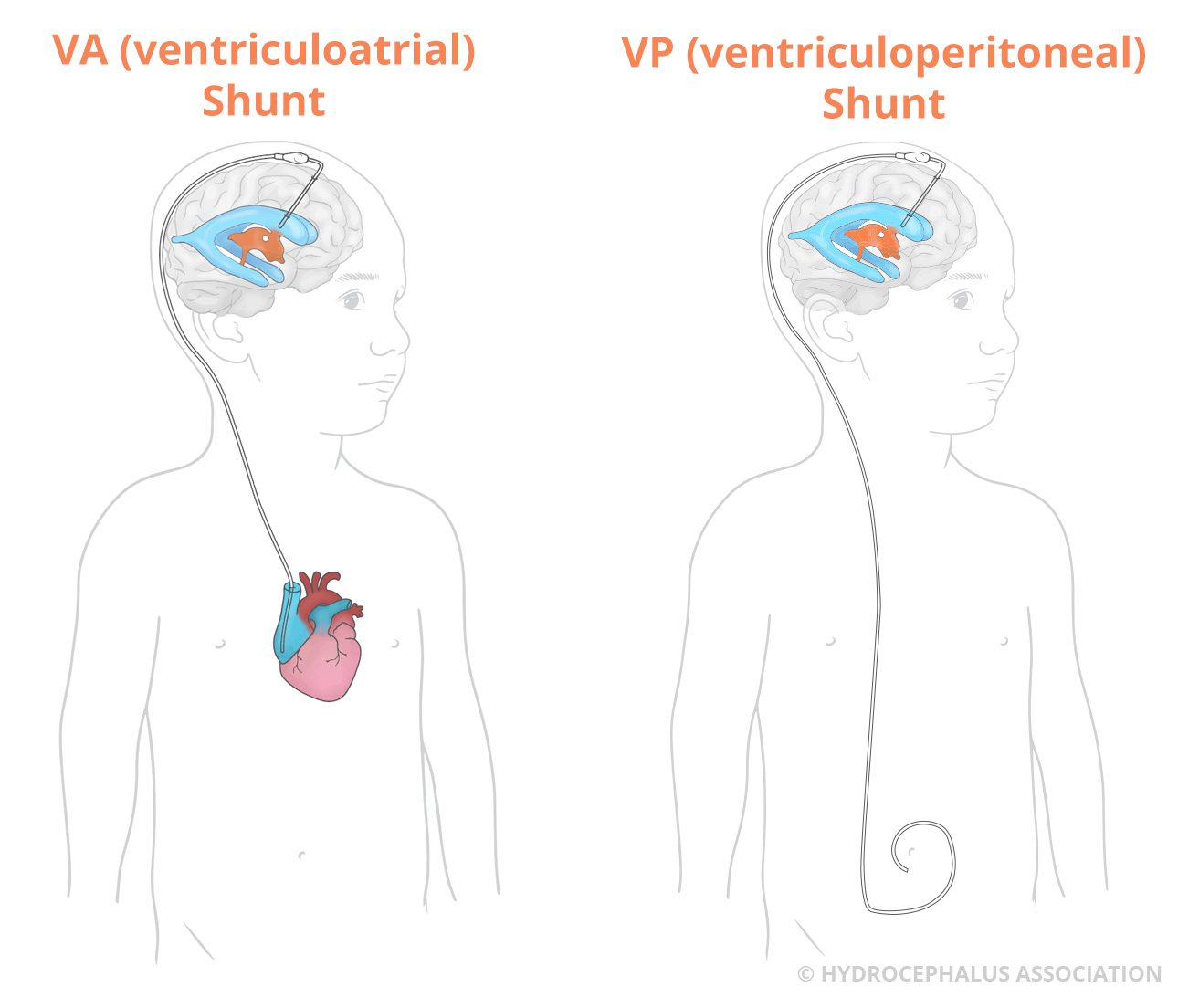 Shunts to treat hydrocephalus - Resource Library - Sheffield Children's NHS  Foundation Trust